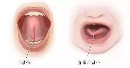 舌系帶過長影響孩子發音，嚴重不會說話